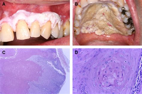 Proliferative verrucous leukoplakia: An update : Journal of  .